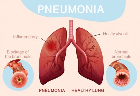 Pneumonia